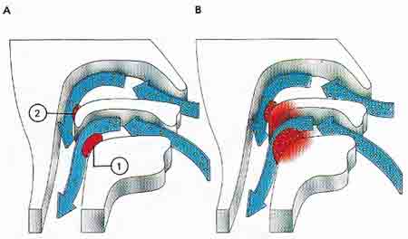 tonsils and tonsilitis