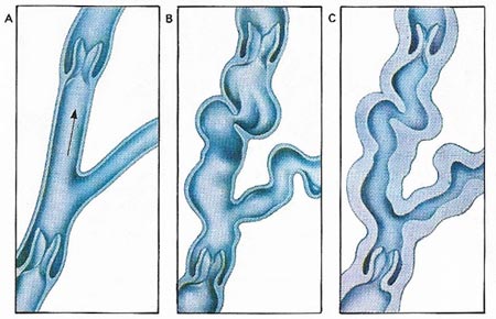 varicose veins