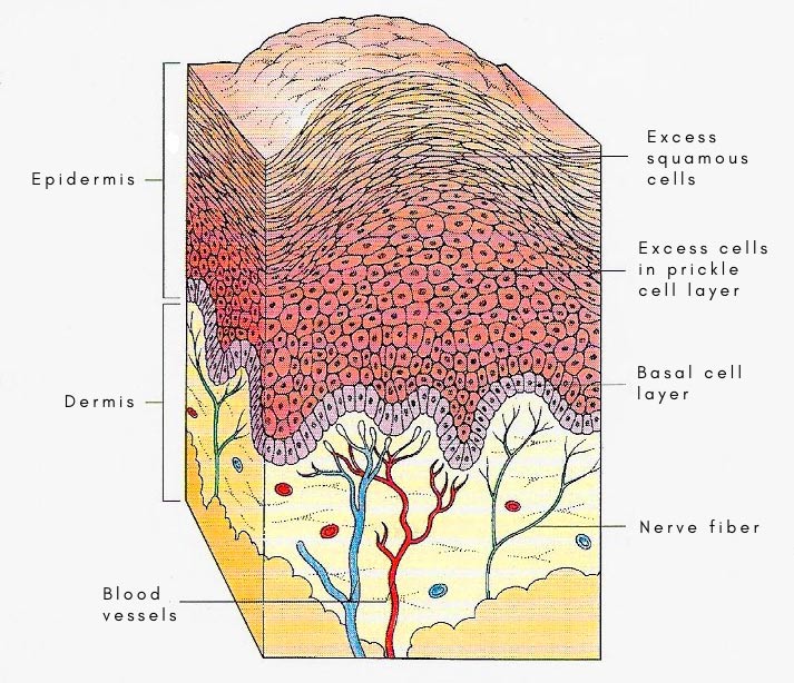 anatomy of a wart