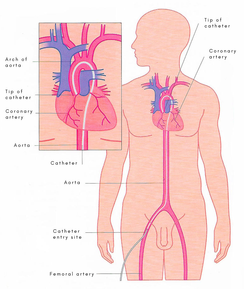 coronary angiography