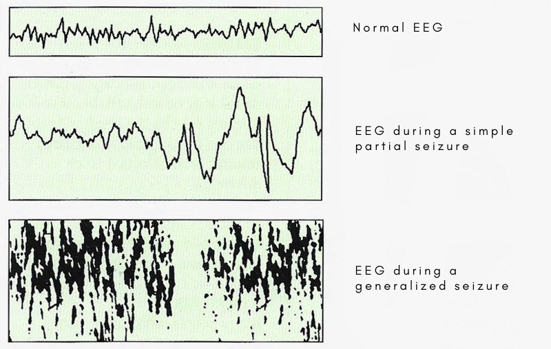 EEGs traces in normal and epileptic states