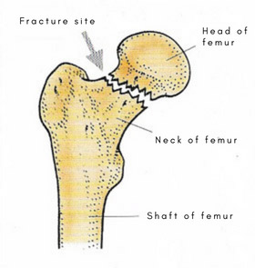 Fracture of neck of femur
