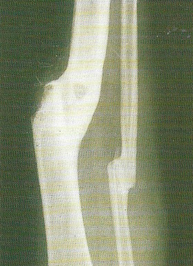Fracture of the fibula and tibia