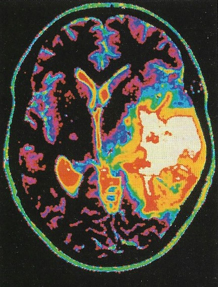 Brain scan showing an oligodendroglioma