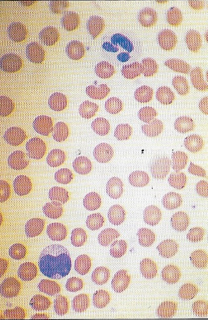 Atypical mononuclear cells (blue)