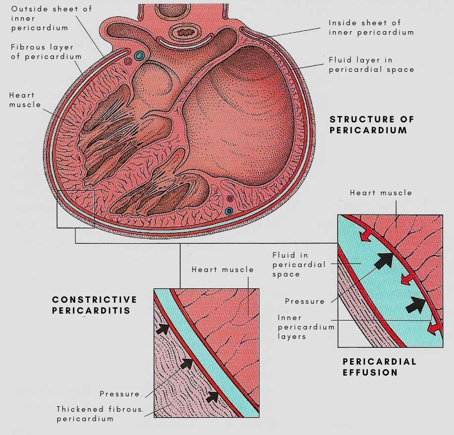 Constrictive pericarditis and pericardial effusion